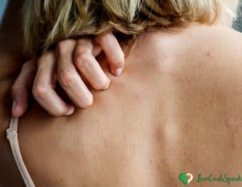 What is Keto Rash? Causes and Treatment